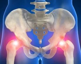 cause dell'artrosi dell'articolazione dell'anca