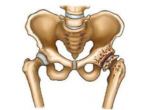 che cos'è l'artrosi dell'articolazione dell'anca