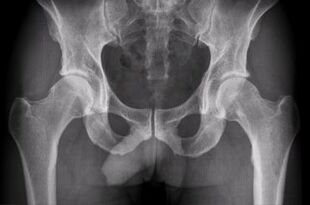 opzioni per la diagnosi dell'artrosi dell'articolazione dell'anca