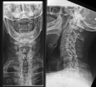 Radiografia del rachide cervicale un metodo per diagnosticare l'osteocondrosi
