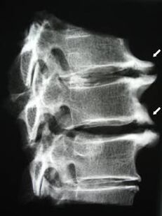 Gli osteofiti del rachide cervicale causano dolore al collo