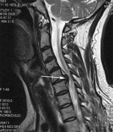 Il danno al midollo spinale provoca dolore al collo