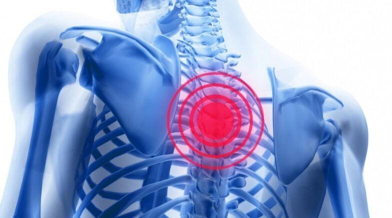 il dolore alla schiena può essere associato a un'ernia del disco