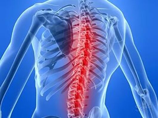 la malattia della colonna vertebrale causa mal di schiena