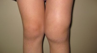 La deformazione del ginocchio