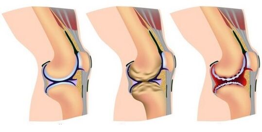 un'articolazione sana e dolore nella distruzione dell'articolazione del ginocchio