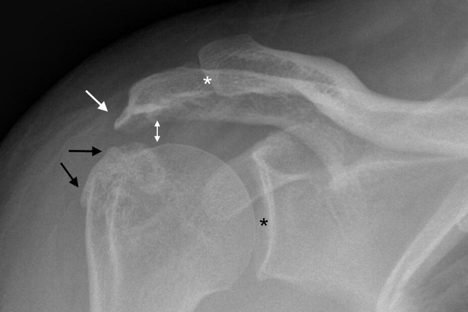 artrosi dell'articolazione della spalla ai raggi X