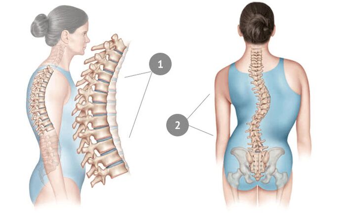 curvatura spinale come causa di osteocondrosi toracica