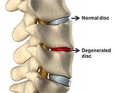 normale disco della colonna vertebrale, disco danneggiato