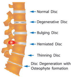 vari danni del disco della colonna vertebrale